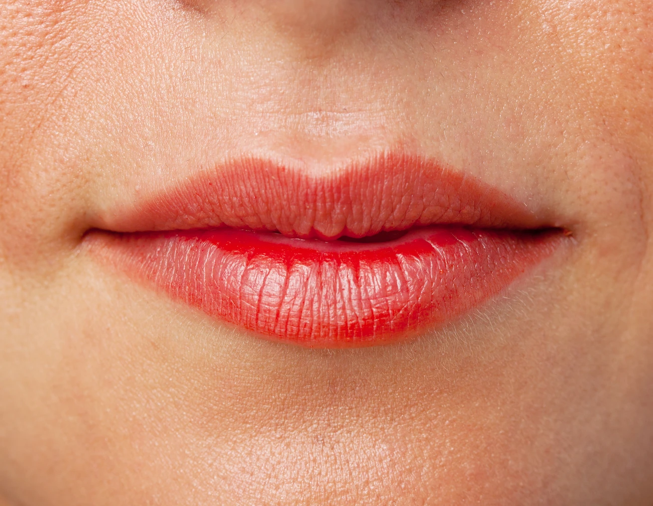 Queiloplastia secundaria: corrección de los labios (deformidades)