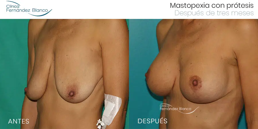Antes y después de una mastopexia sin cicatriz, realizada en la Clínica FB