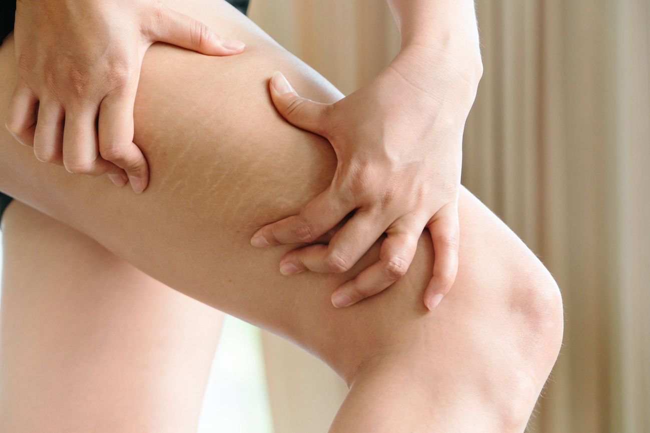 Celulitis tratamiento con Velasmooth