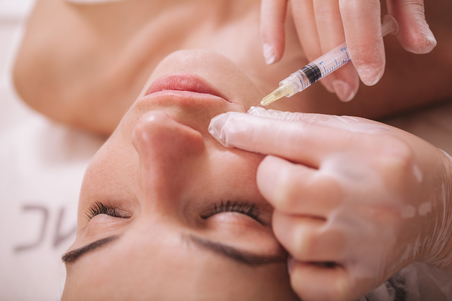 ¿Radiesse que es y por qué se recomienda este relleno facial?