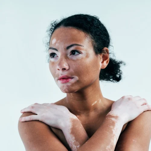 White spots: what is idiopathic guttate hypomelanosis?