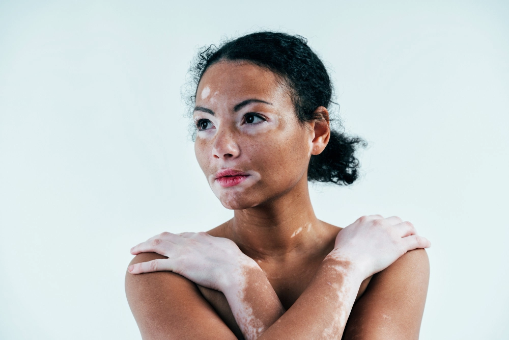 White spots: what is idiopathic guttate hypomelanosis?