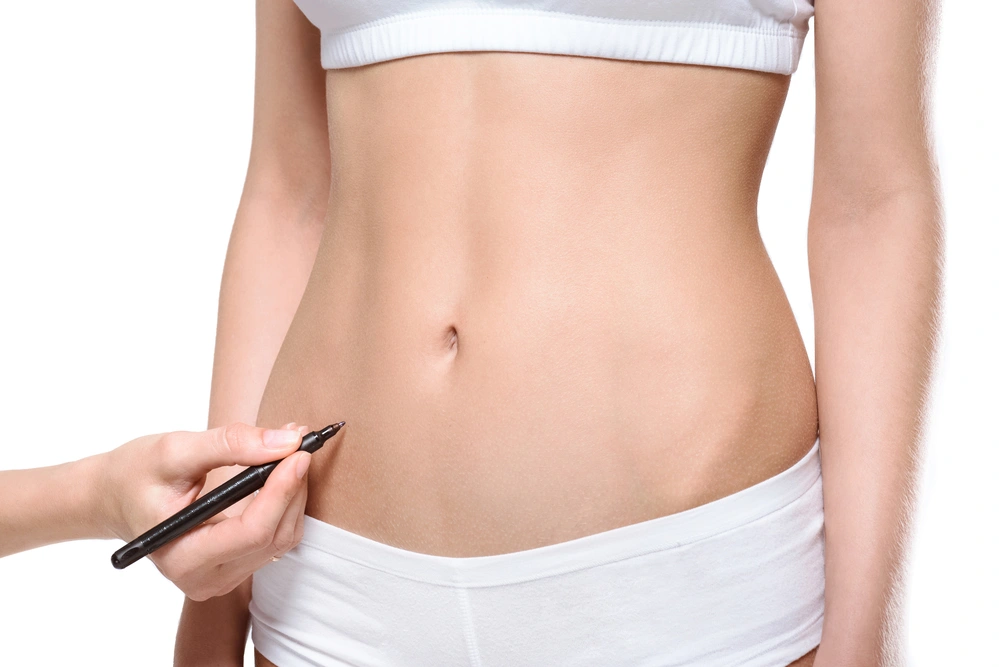 Liposucción abdominal para la mujer - Expertos en Medicina Estética