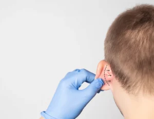 Secondary Otoplasty or Secondary Cosmetic Ear Surgery