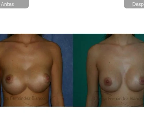 A balanced equation: breast size and cleavage