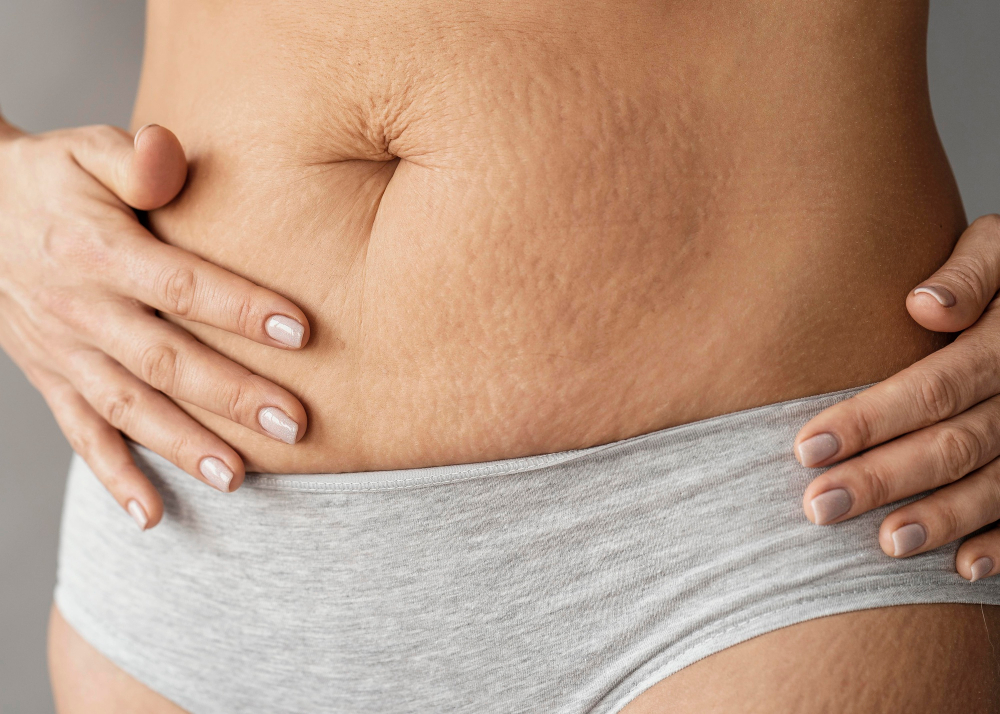 Modelar el contorno con Mesoterapia y Vela Smooth: ¿Cómo funciona y qué resultados esperar?