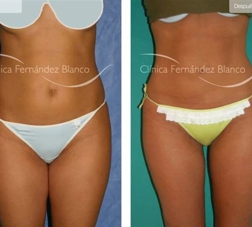 What results can you expect from having liposuction in due time?
