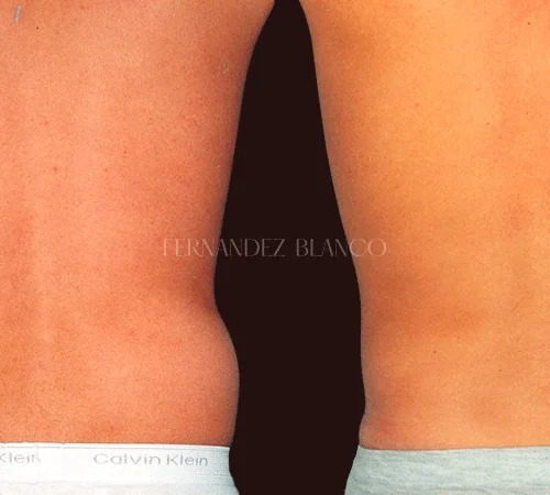 Primary secondary tertiary liposuction case