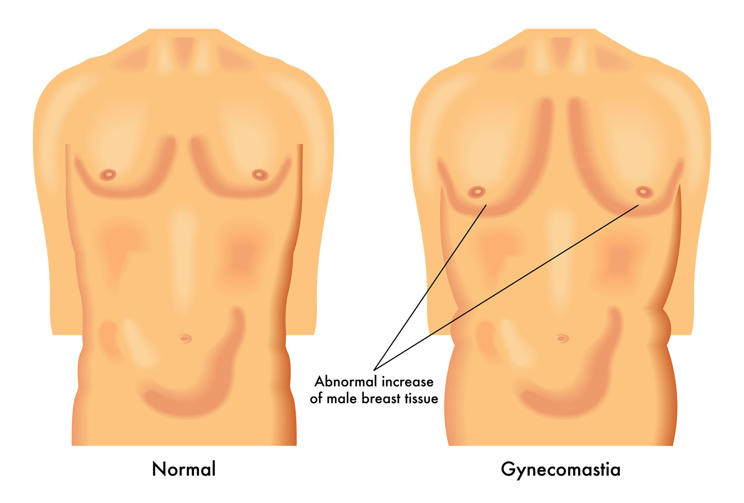 Ginecomastia ginecoplastia