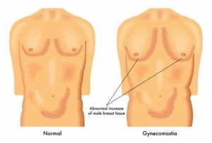 Gynecomastia: Gynecoplasty