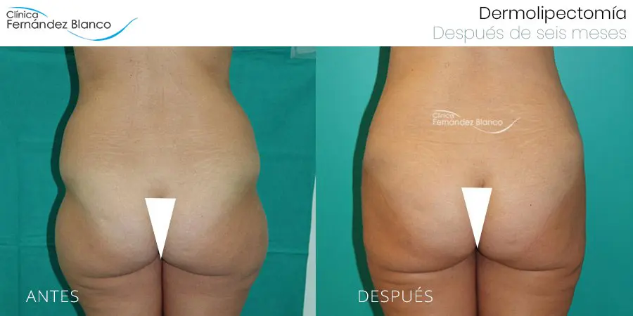 Antes y después de dermolipectomía abdominal realizada en Clínica FB