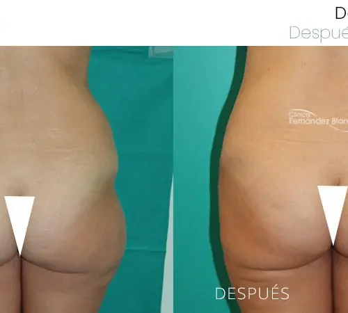 Before and after abdominal dermolipectomy performed at Clínica FB