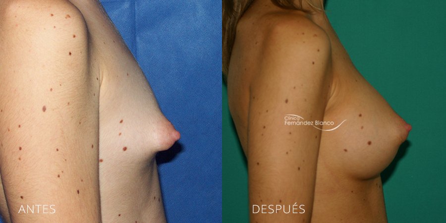 Operación mamas tuberosas: Más que estética, una solución para el bienestar emocional