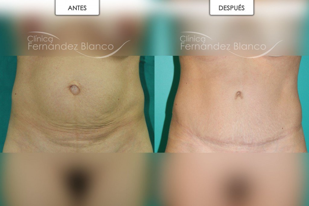 Fotos antes y después de una dermolipectomia con abdominoplastia