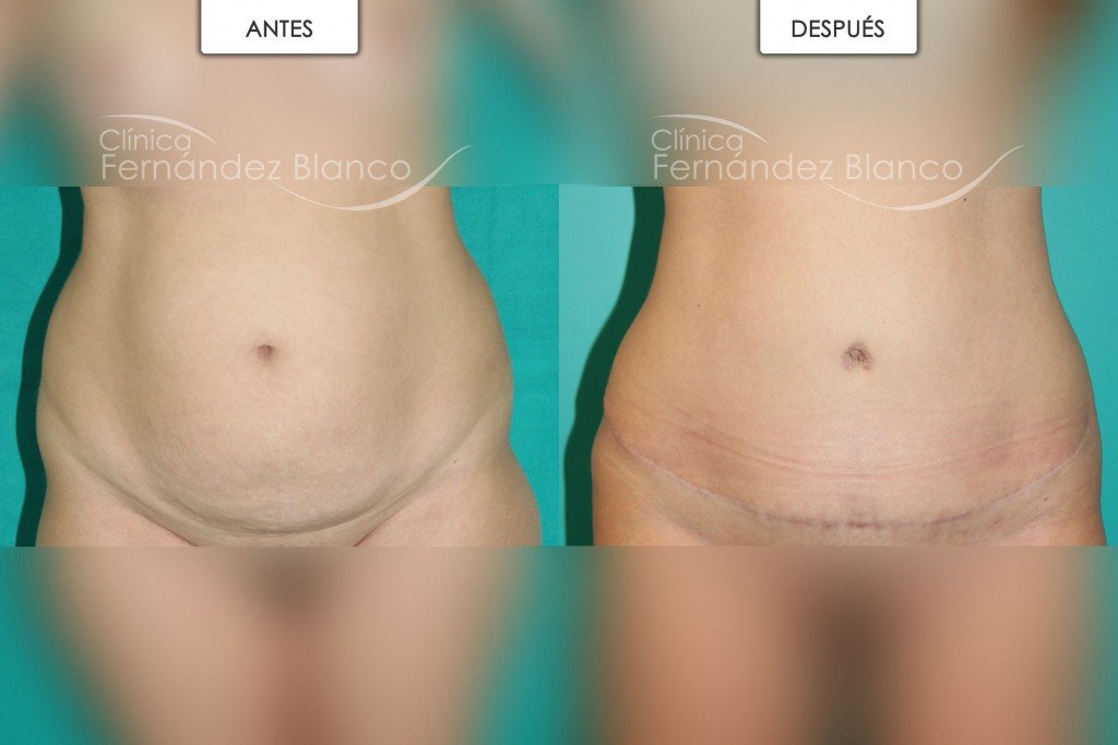 Fotos antes y después de una abdominoplastia con dermolipectomia