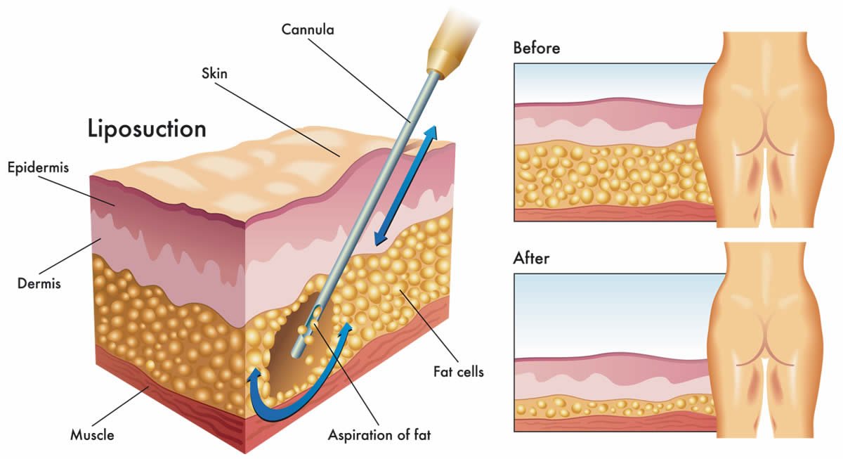 Representación visual de dónde se coloca la cánula para realizar una liposucción o lipoaspiración