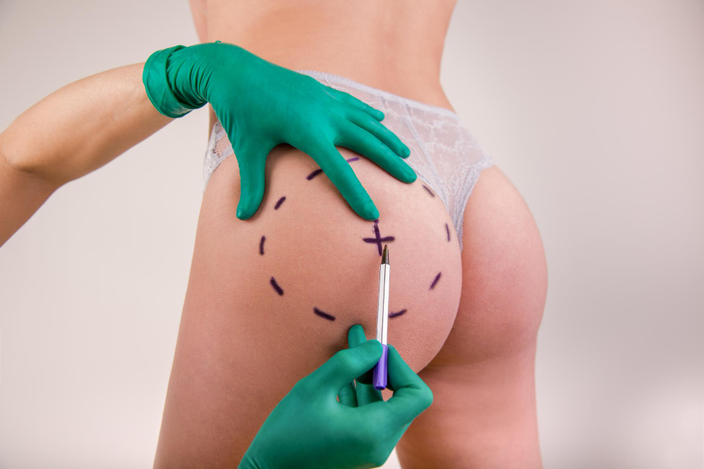 Why has Beyoncé's buttock augmentation increased demand for gluteoplasty?