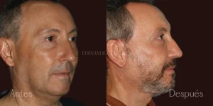 Caso de lifting facial donde se meustra el antes y depsues de una técnica de estiramiento facial