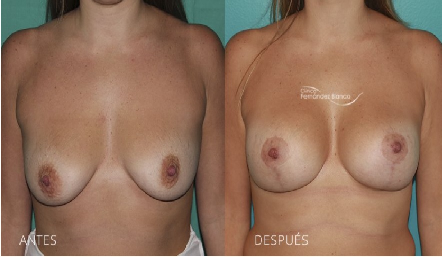 Vista frontal de una pexia mamaria antes y después realizada en la Clínica Fernández Blanco