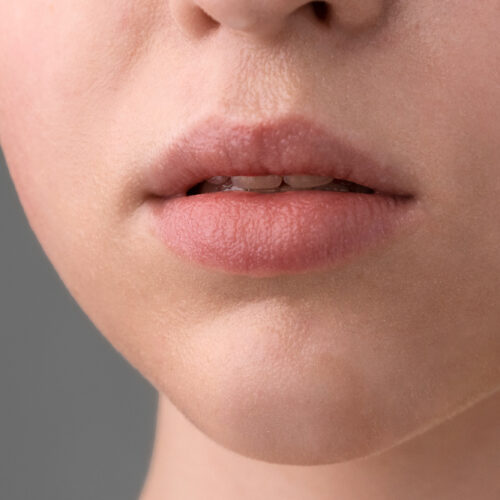 Cheiloplasty surgery: what is it and why is it trendy?