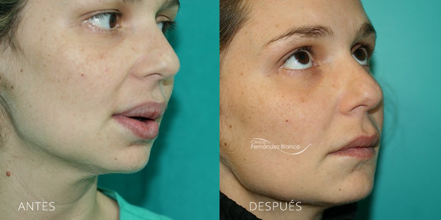 Fotografía del antes y después extracción de biopolímeros en labios. Cirugía realizada en la Clínica FB