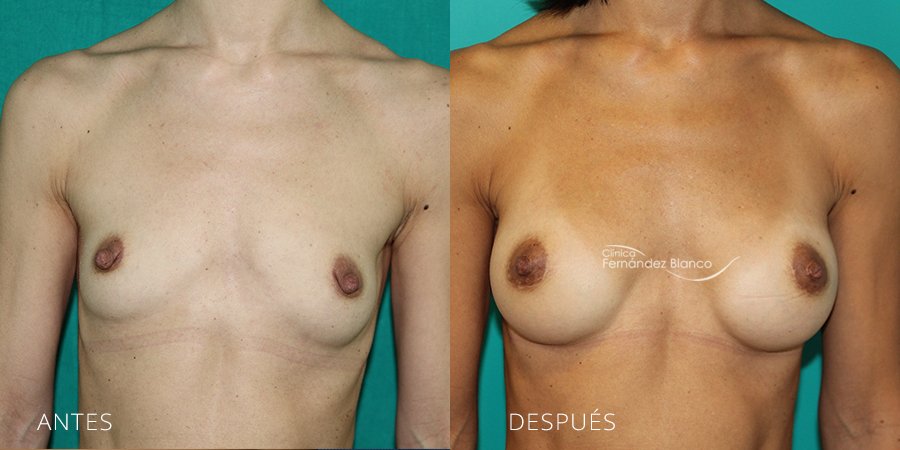 Breast augmentation Case 1