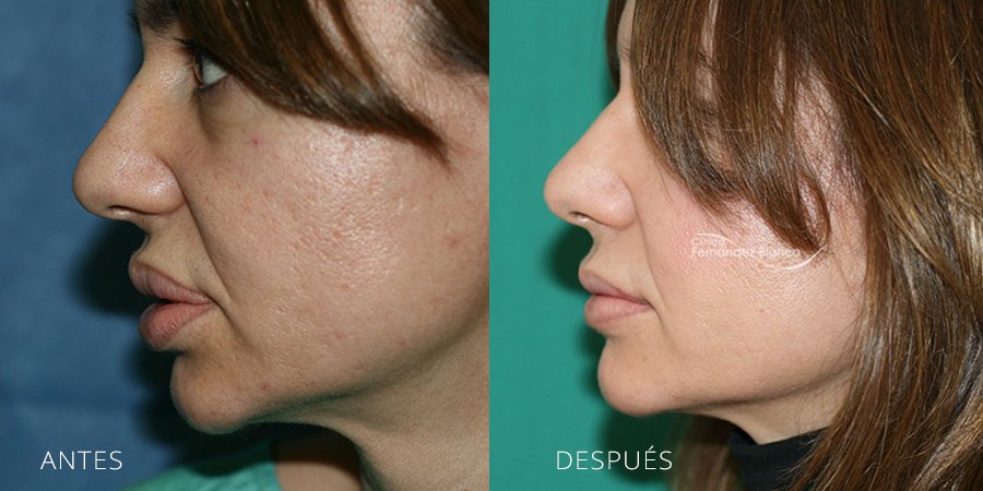 Extracción de Polímeros de labio superior e inferior, cuatro meses de recuperacion, queiloplastia secundaria, clinica Fernández Blanco, vista de perfil