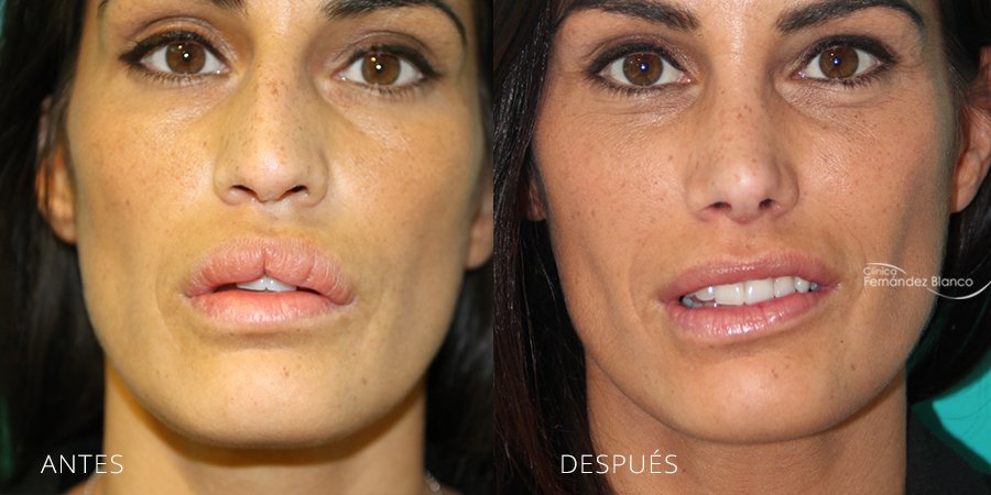 rinoplastia en madrid, operacion de nariz, casos reales,antes y despues, pacienta del dr Fernández Blanco