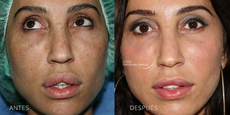 Extracción de Polímeros, relleno en labio superior e inferior, dos meses de recuperacion, queiloplastia, clinica Fernández Blanco