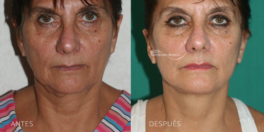 Vista frontal del antes y después de un lifting facial