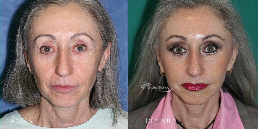 Antes y después de lifting facial en Marbella. Cirugía realizada en la Clínica FB