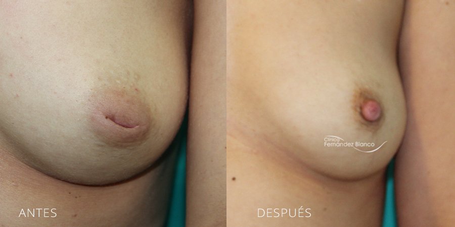 Inverted nipple Case 1