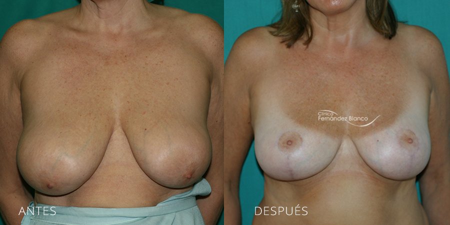 Reducción de mamas Caso 4