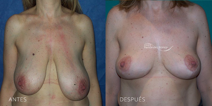 Reducción de mamas Caso 5