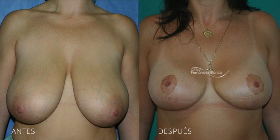 Reducción de mamas Caso 6