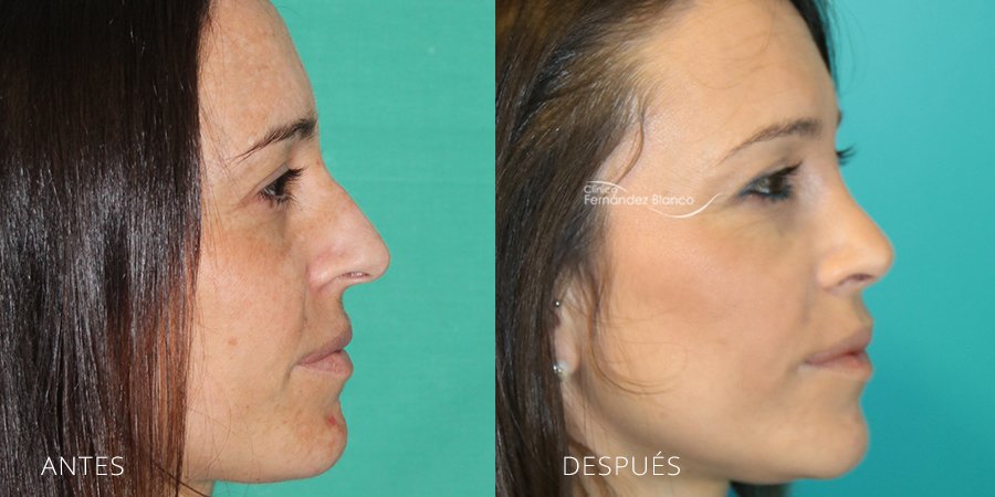 rinoplastia en madrid, operación nariz, rinoplastia resultados, antes y despues, casos reales, paciente del cirujano plastico Dr Fernández Blanco, vista de perfil