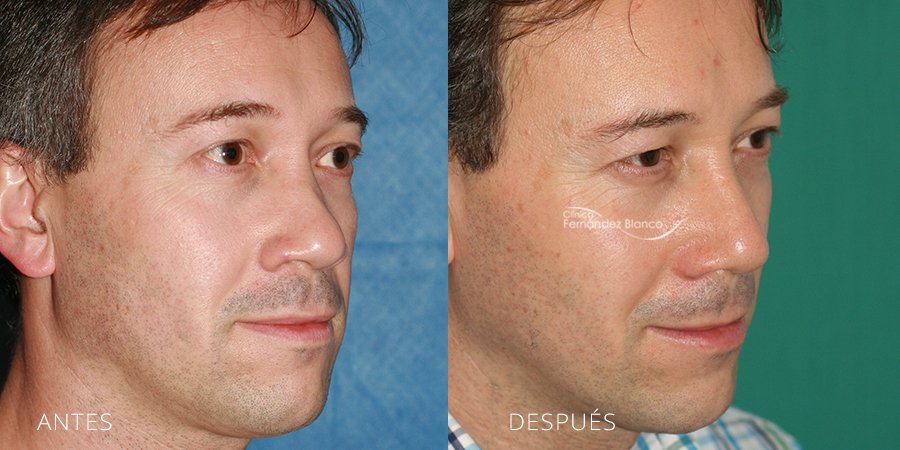 rinoplastia en madrid, casos reales, cirugía de nariz, fotos de antes y despues, paciente del cirujano plastico Dr Fernández Blanco, vista de medio perfil