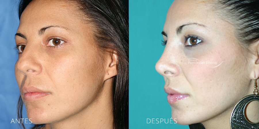 cirugía de nariz, rinoplastia madrid, casos reales, rinoplastia fotos antes y despues, clinica Fernández Blanco, vista de medio perfil