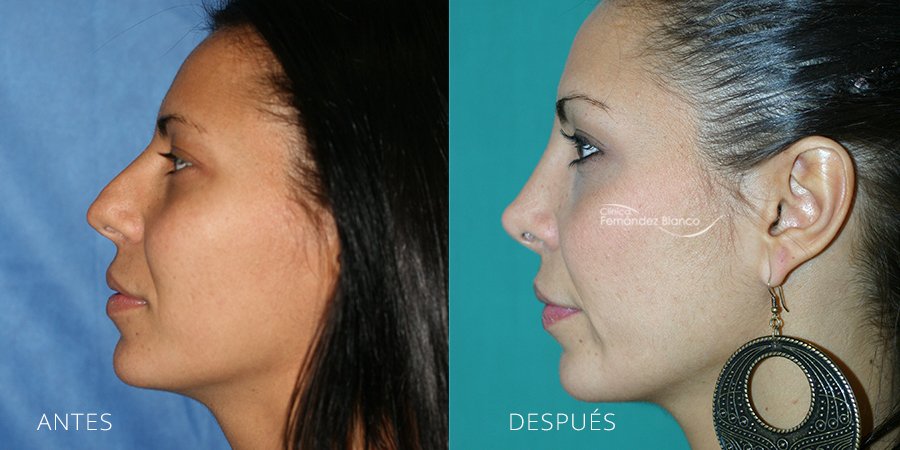 cirugía de nariz, rinoplastia madrid, casos reales, rinoplastia fotos antes y despues, clinica Fernández Blanco, vista de perfil