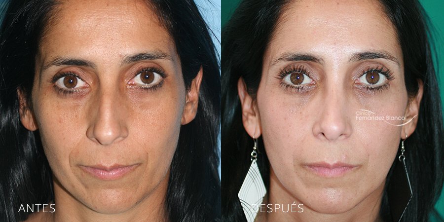 septoplastia, rinoplastia madrid, cirugía de nariz, antes y despues, casos reales, paciente del Dr Fernández Blanco