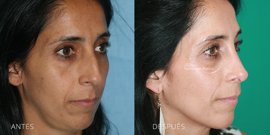 septoplastia, rinoplastia marbella, cirugía de nariz, antes y despues, casos reales, paciente del Dr Fernández Blanco, vista de medio perfil