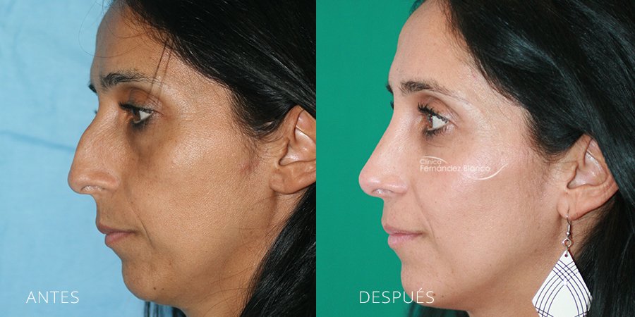 septoplastia, rinoplastia madrid, cirugía de nariz, antes y despues, casos reales, paciente del Dr Fernández Blanco, vista de perfil