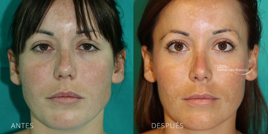 rinoplastia resultados, antes y despues, operacion de nariz, fotos de antes y despues, clinica Fernández Blanco