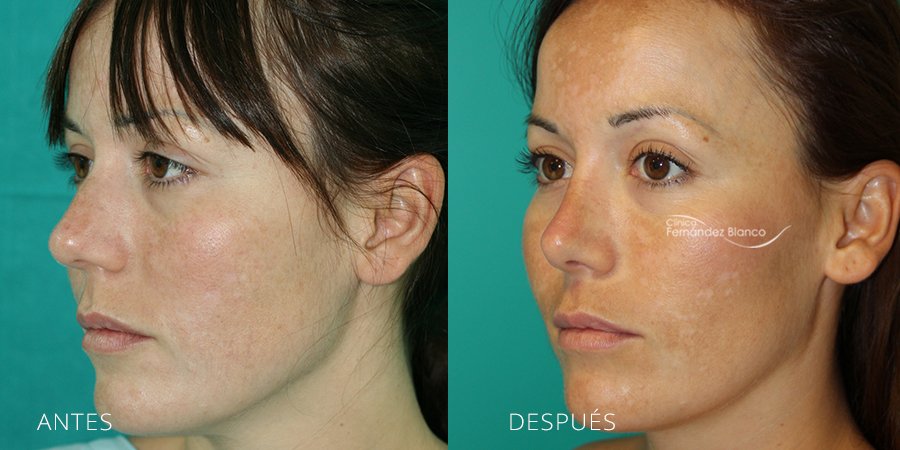 rinoplastia resultados, antes y despues, operacion de nariz, fotos de antes y despues, clinica Fernández Blanco, vista de medio perfil