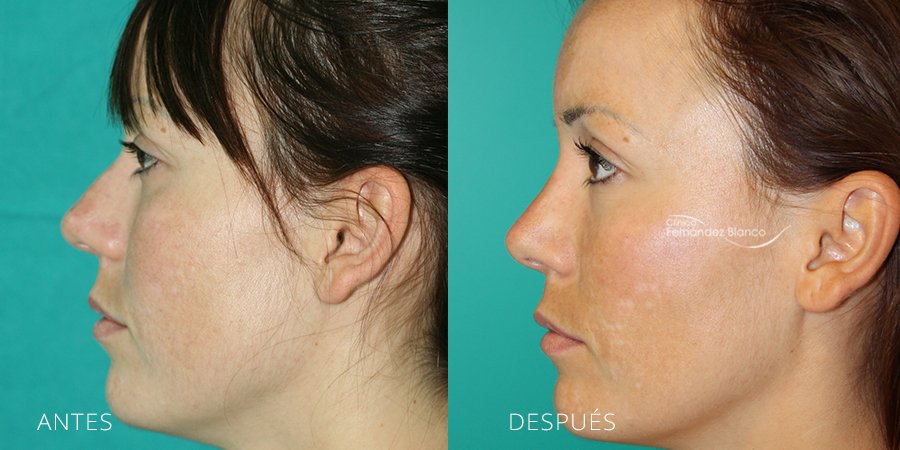 rinoplastia resultados, antes y despues, operacion de nariz, fotos de antes y despues, clinica Fernández Blanco, vista de perfil