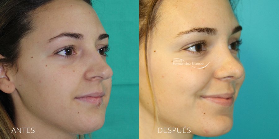 fotos de antes y despues rinoplastia, cirugia de nariz en madrid, operacion de nariz resultados, paciente del dr Fernández Blanco, vista de medio perfil