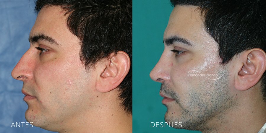 rinoseptumplastia, rinoplastia marbella, rinoplastia hombre, paciente del cirujano plastico Dr Fernández Blanco, vista de medio perfil