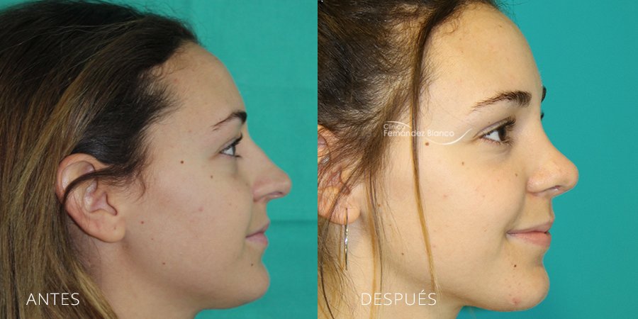 fotos de antes y despues rinoplastia, cirugia de nariz en marbella, operacion de nariz resultados, paciente del dr Fernández Blanco, vista de perfil