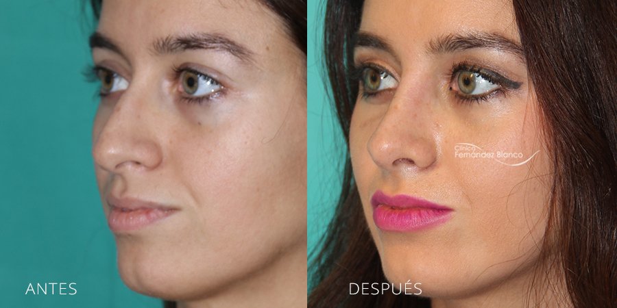 rinoplastia en madrid, operacion de nariz, antes y despues, casos reales, dr Fernández Blanco, vista de medio perfil