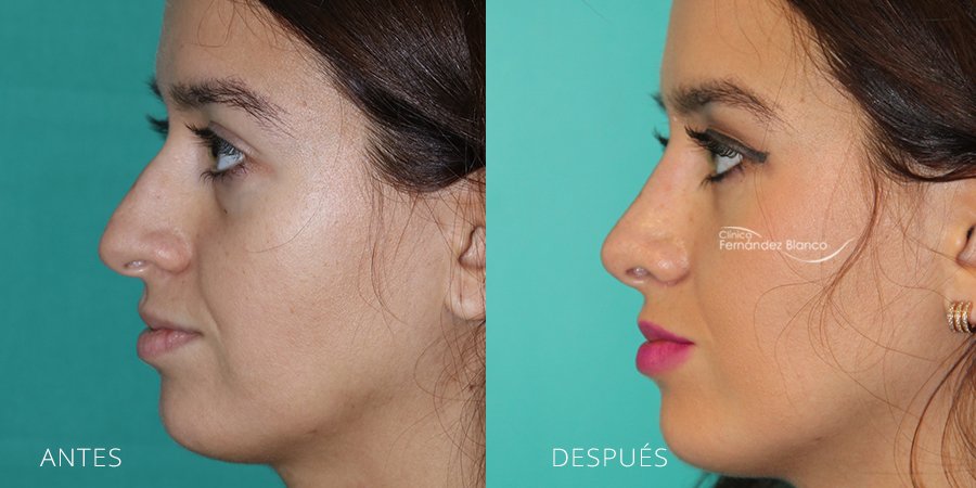 rinoplastia en marbella, operacion de nariz, antes y despues, casos reales, dr Fernández Blanco, vista de perfil